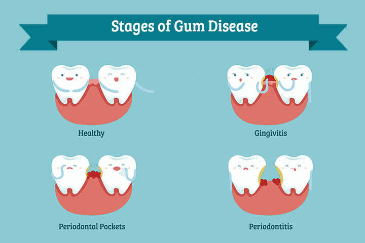 Stages of Gum Disease - Creating Smiles Dental - Clearwater & St. Petersburg FL