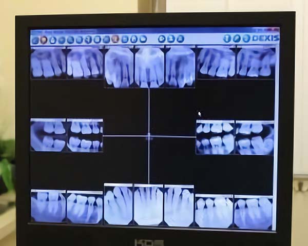 Dexis Dental Digital Radiography - Creating Smiles Dental - Clearwater & St. Petersburg FL