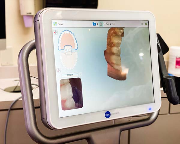 iTero 3D Scanner - Creating Smiles Dental - Clearwater & St. Petersburg FL
